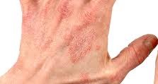 Dermatitis information sheet